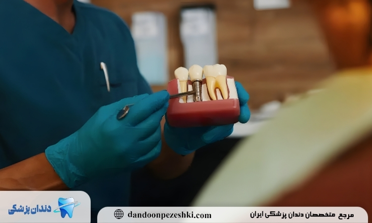 ایمپلنت دندان