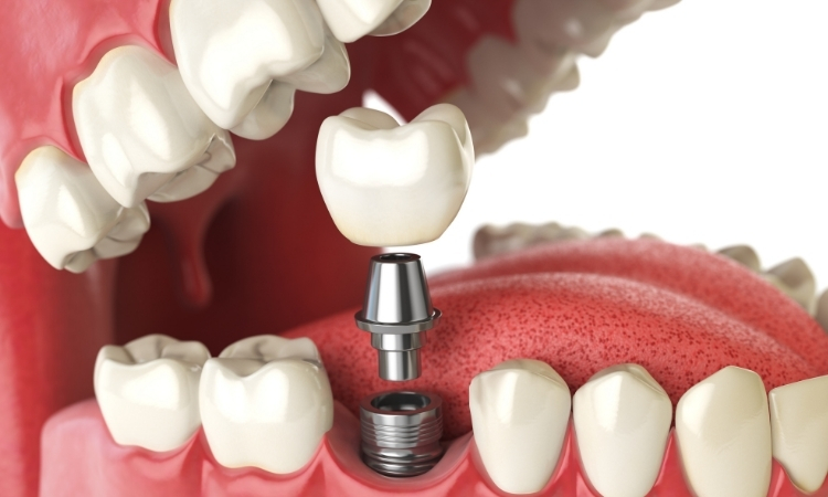 درآوردن ایمپلنت دندان