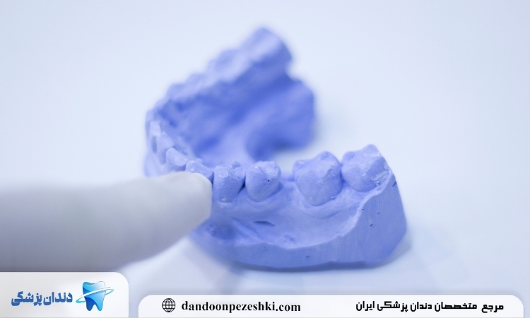  قالبگیری دندان