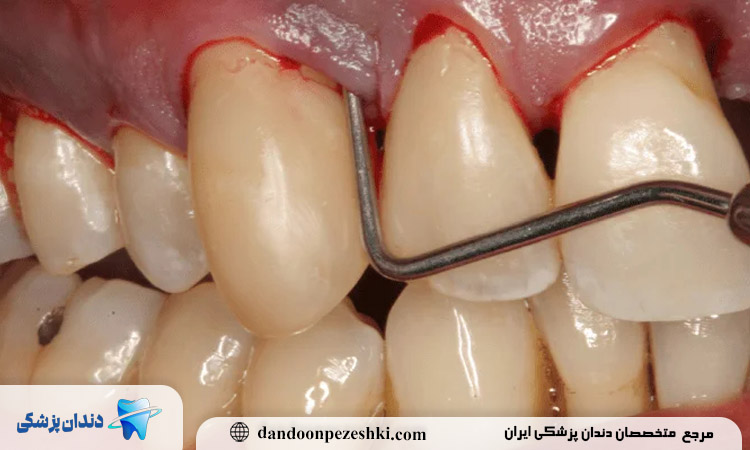 علت جدایی لثه