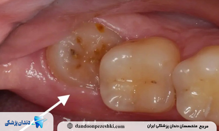 درمان دندان عقل نیمه نهفته