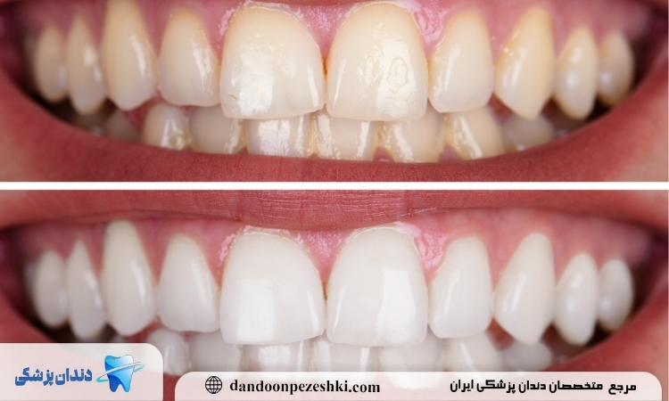 درمان زردی دندان