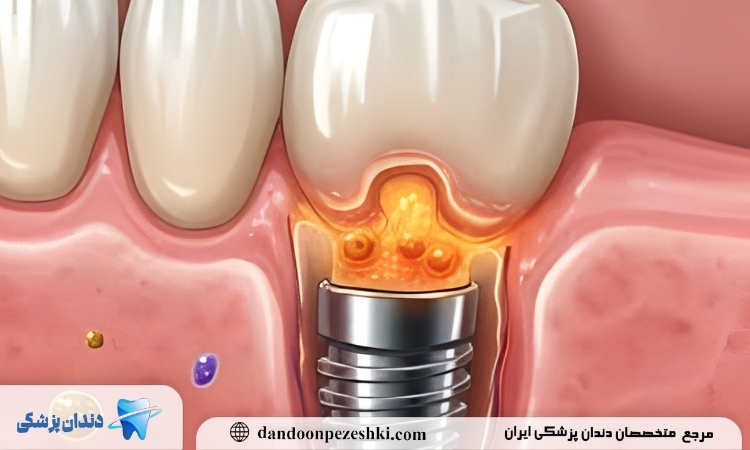 ایمپلنت دندان