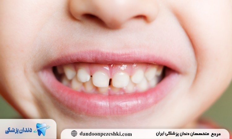 آسیب دندان کودکان