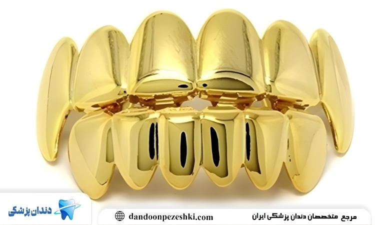 تاج دندان طلا