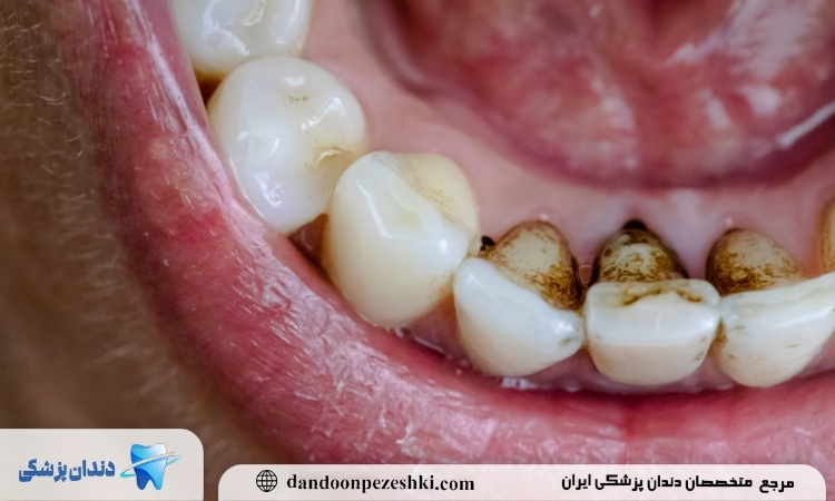 لکه های قهوه ای بر روی دندان
