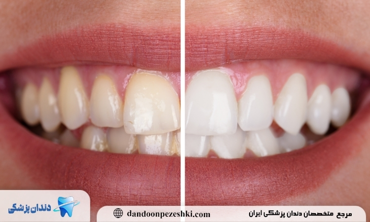 زرد شدن دندان