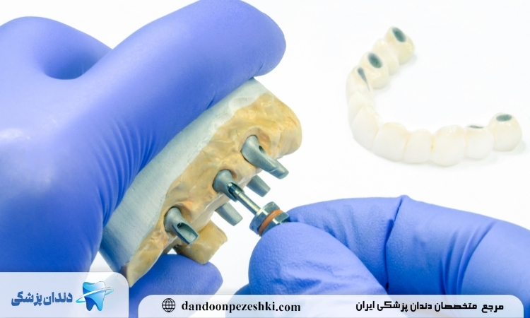 ایمپلنت دندان