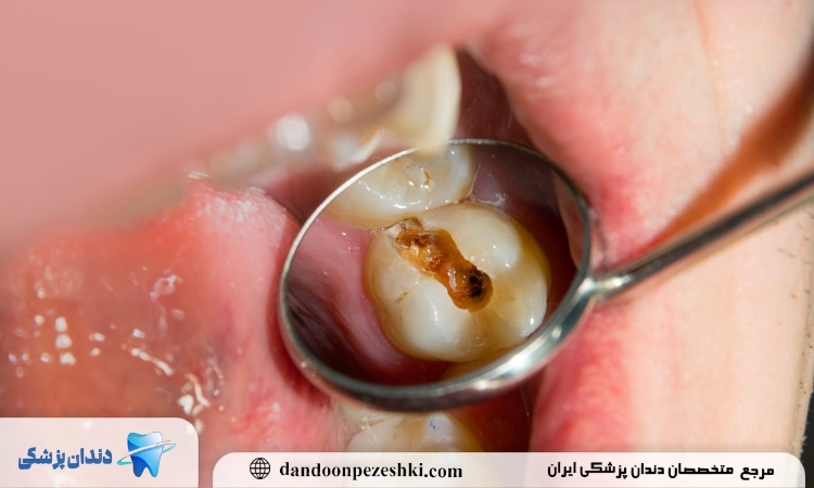 عفونت دندان