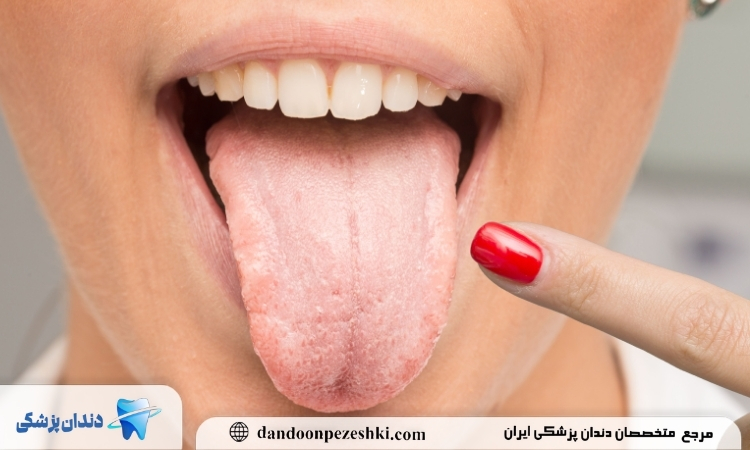دلایل، علائم و راه های درمان برفک دهانی