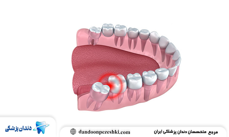 دندان عقل نیمه نهفته چیست و چه عوارضی دارد؟