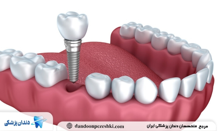 ایمپلنت در بیماری قلبی