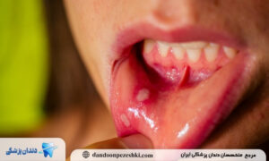 راه های درمان آفت دهان