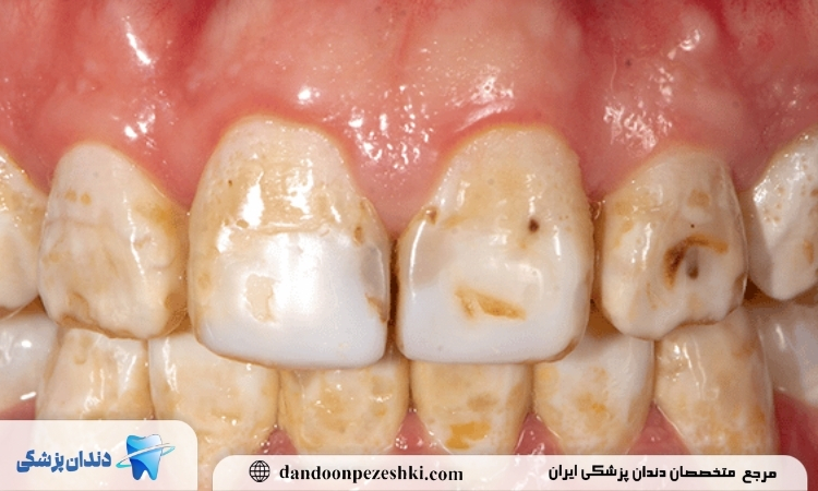 لکه دندان