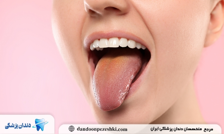 علائم بروز برفک دهانی چیست؟