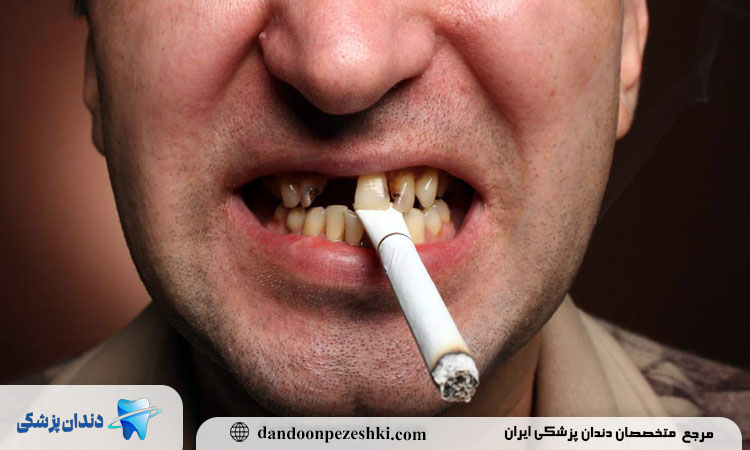 پوسیدگی دندان