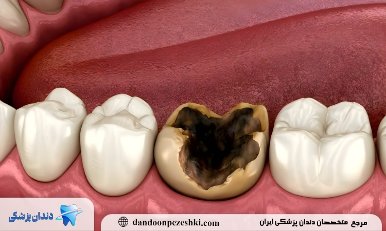 پوسیدگی دندان