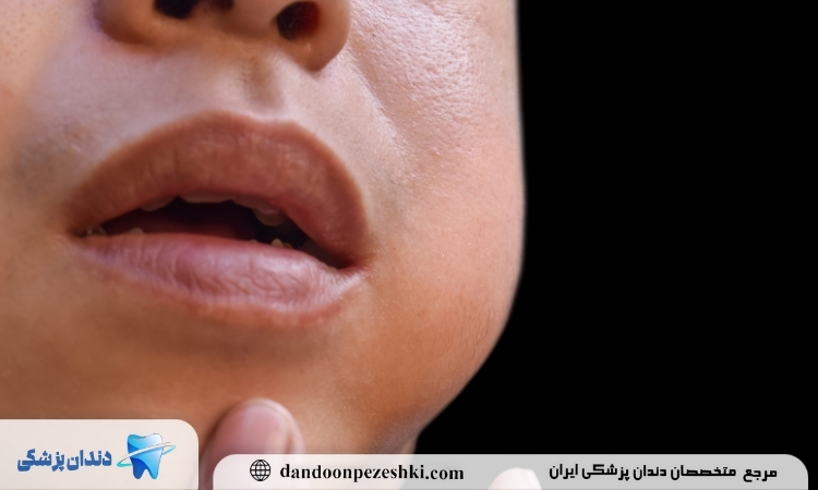 کاهش ورم صورت