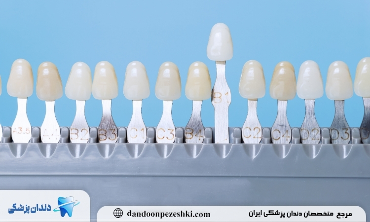 رنگ بندی کامپوزیت دندان