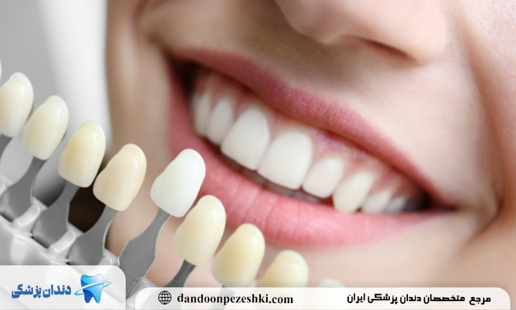 رنگ کامپوزیت دندان