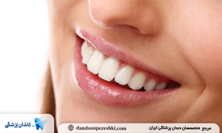 روش سفید کردن دندان