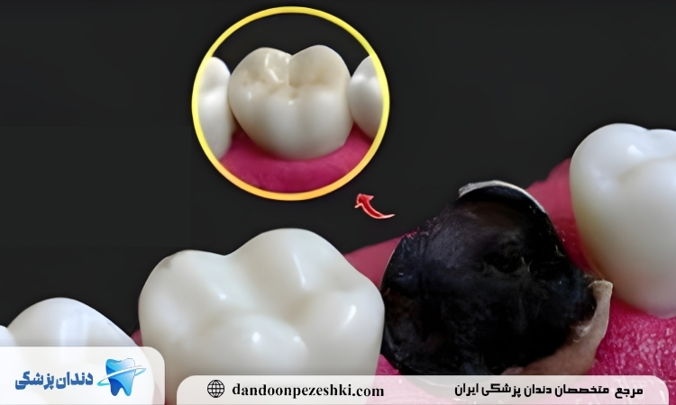 دندان پوسیده