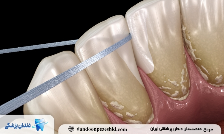 درمان لکه دندان