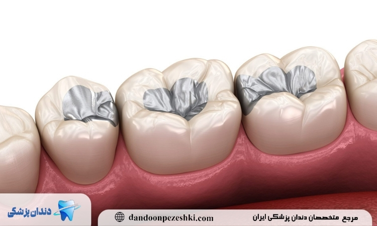 نحوه پر کردن دندان