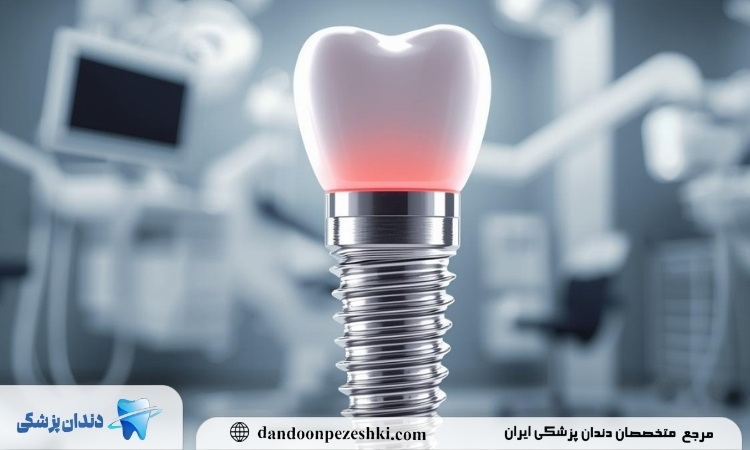 ایمپلنت دندان