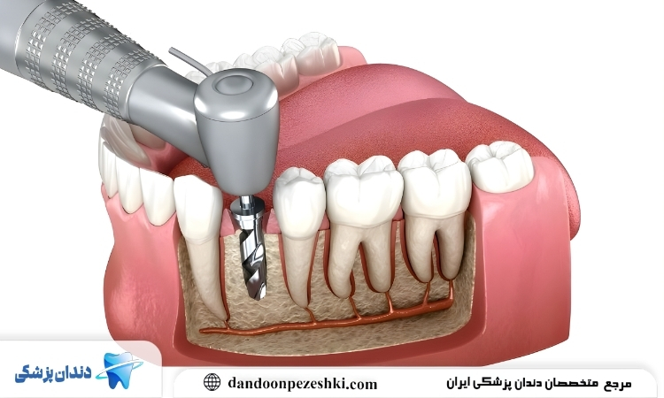 ایمپلنت دندان