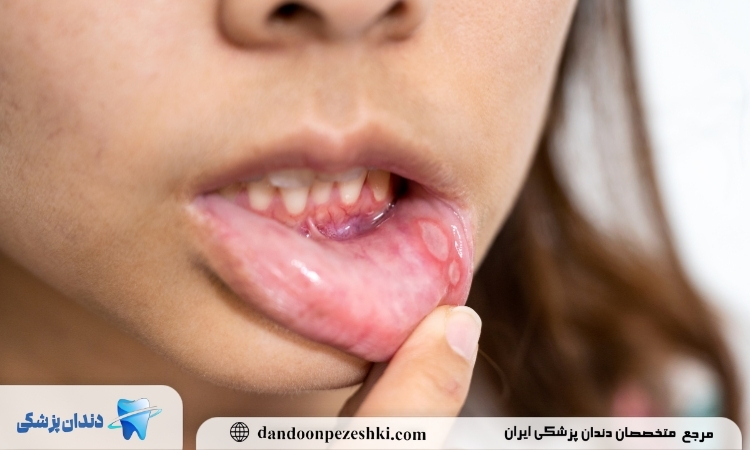 انواع آفت دهان