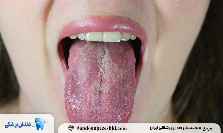 علت بروز برفک دهانی