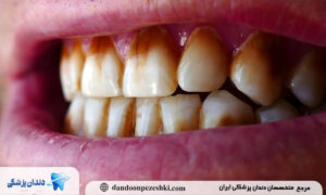 علت ایجاد لکه قهوه ای و زرد روی دندان ها چیست؟
