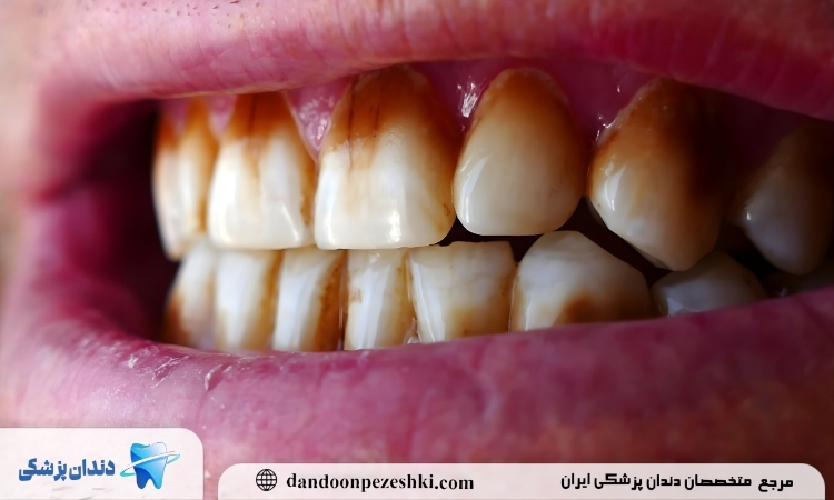 علت ایجاد لکه قهوه ای و زرد روی دندان ها چیست؟