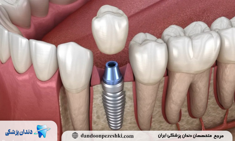 علت تب و لرز بعد از ایمپلنت دندان چیست