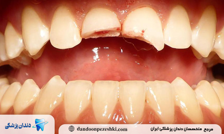 علت خرد شدن دندان جلو