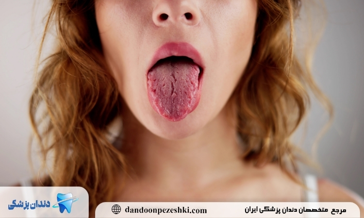 علل خشکی دهان بعد از کامپوزیت