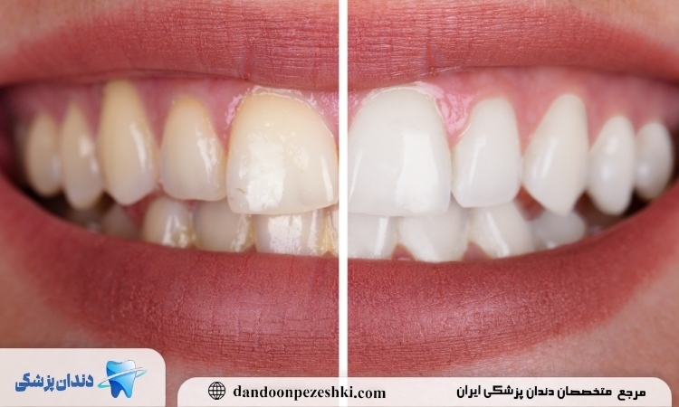 بلیچینگ دندان چیست؟