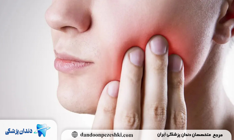 دندان عقل نیمه نهفته