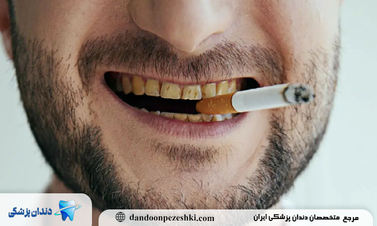 تاثیر سیگار و قلیان بر دندان