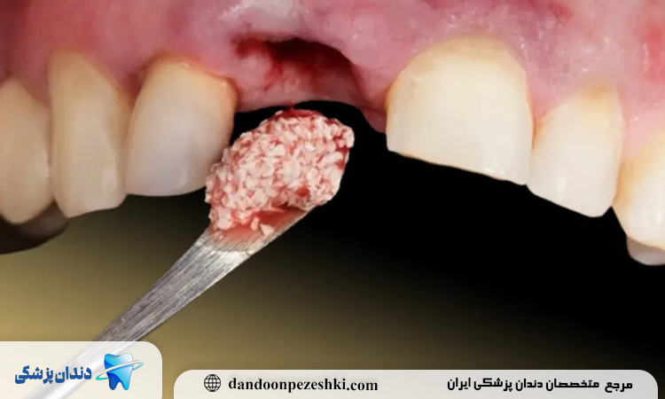 عوارض پیوند استخوان از لگن