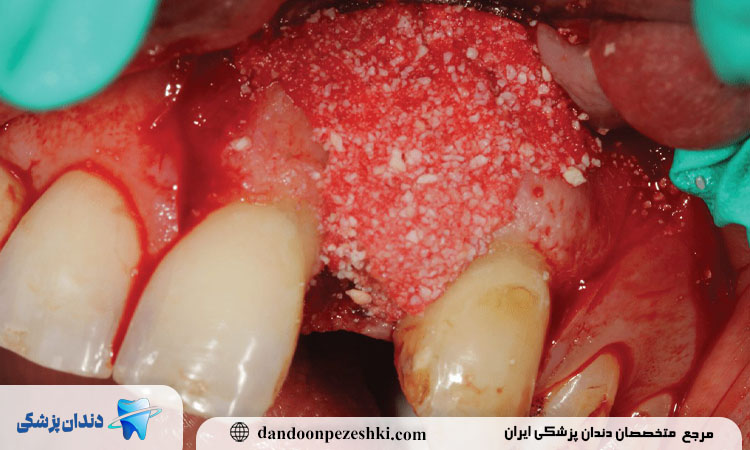 پیوند استخوان فک