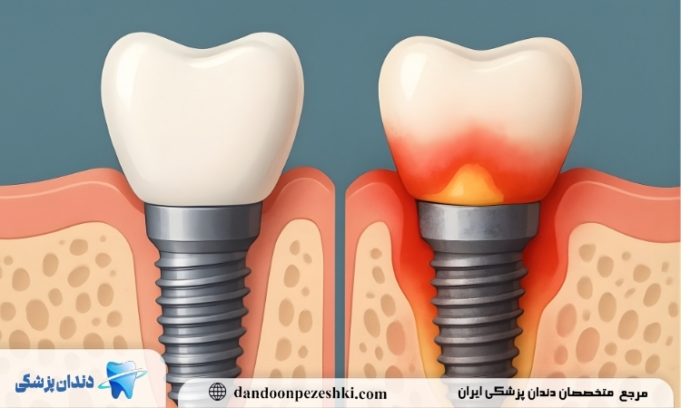 عفونت ایمپلنت دندان