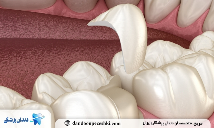 شکستگی دندان