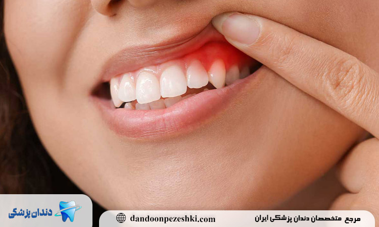 بهبود استخوان فک