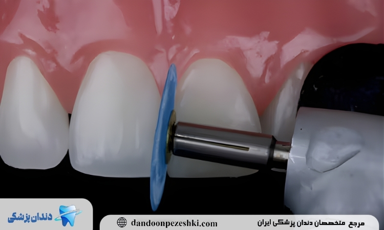 پالیش کامپوزیت