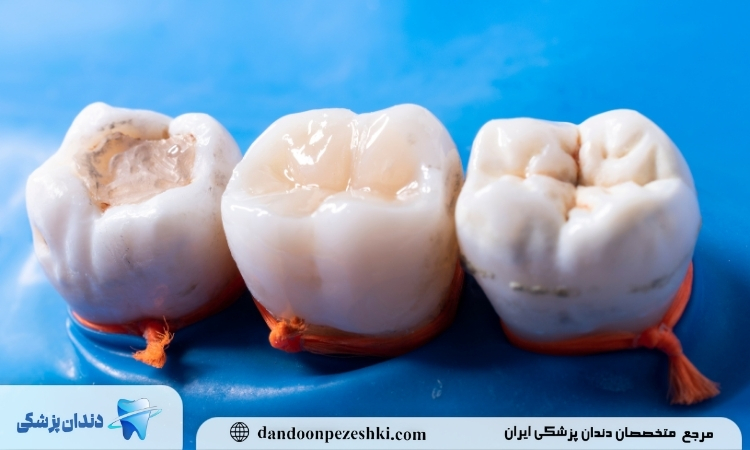عصب کشی دندان