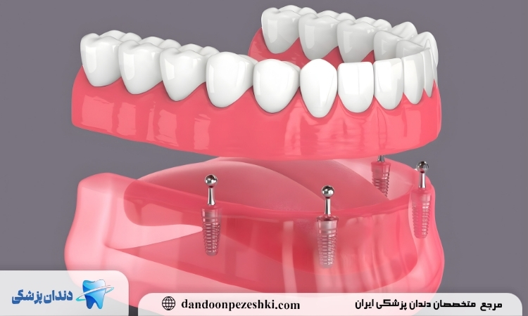 فول موس دندان چیست؟