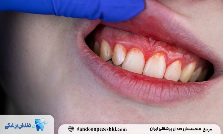 قطع خونریزی دندان با غرغره 