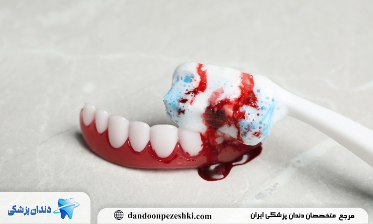 قطع خونریزی دندان